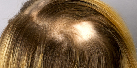 Alopecia Areata.png