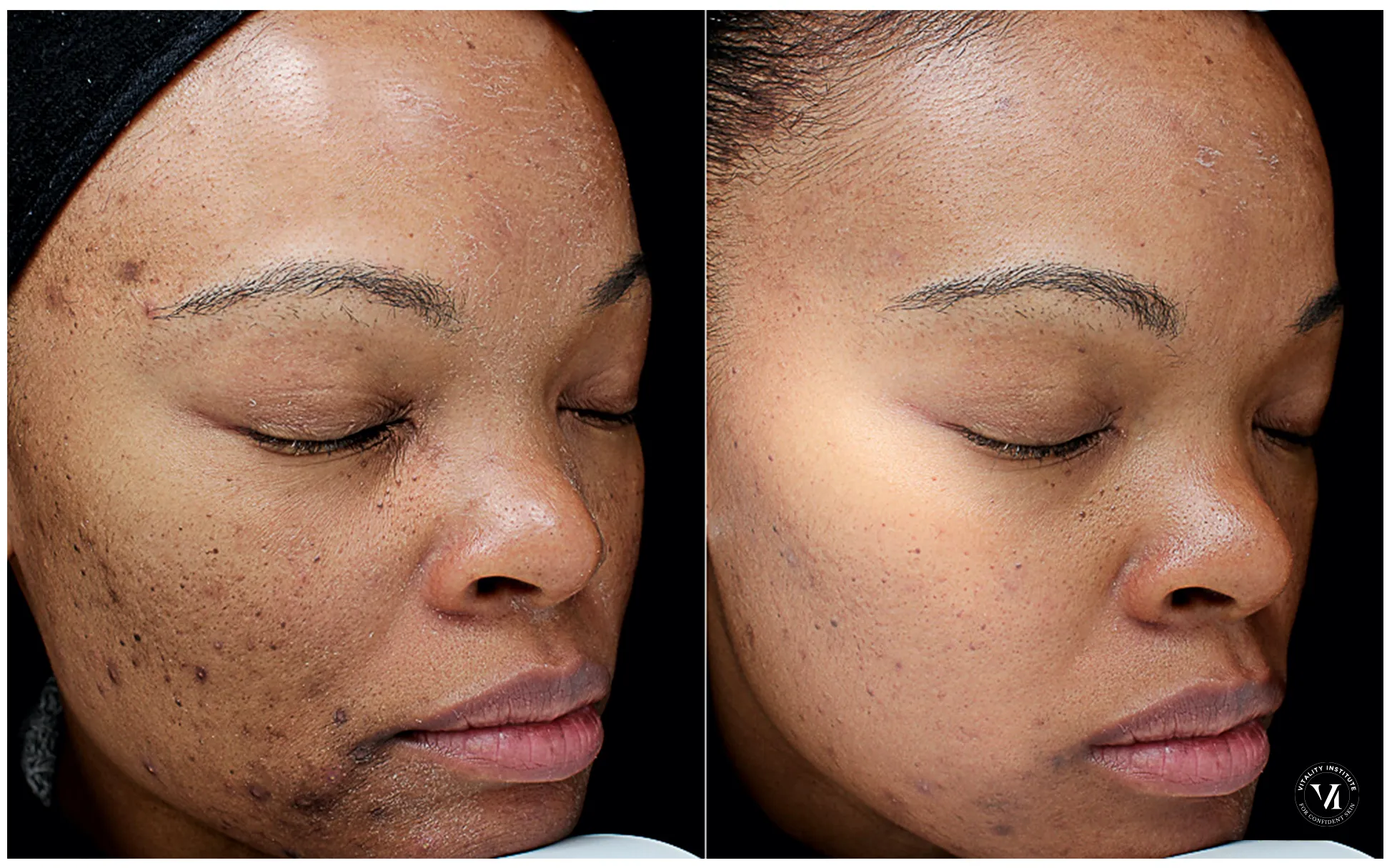 Chemical Peel Before and After 1