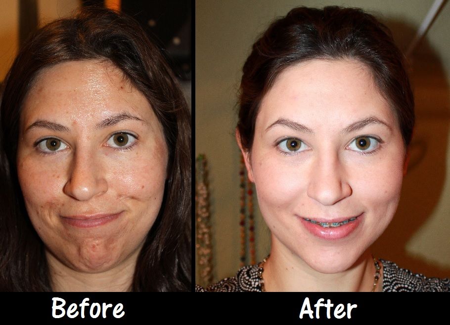 Chemical Peel Before and After 2-