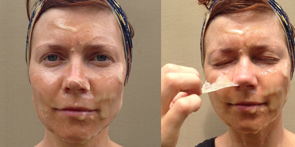 Chemical Peel Before and After 3