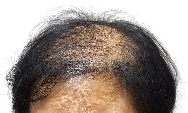 Hair Loss Conditions Aggravated by Stress.jpg