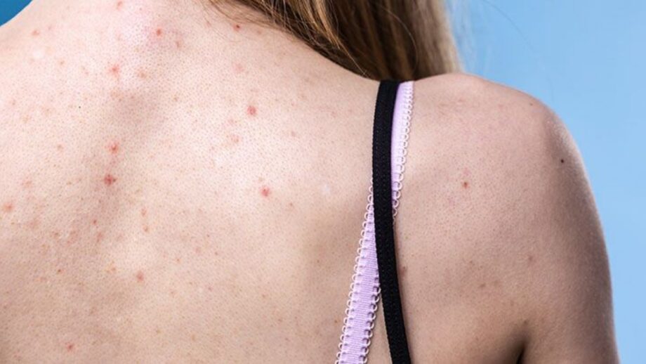 body acne.jpg