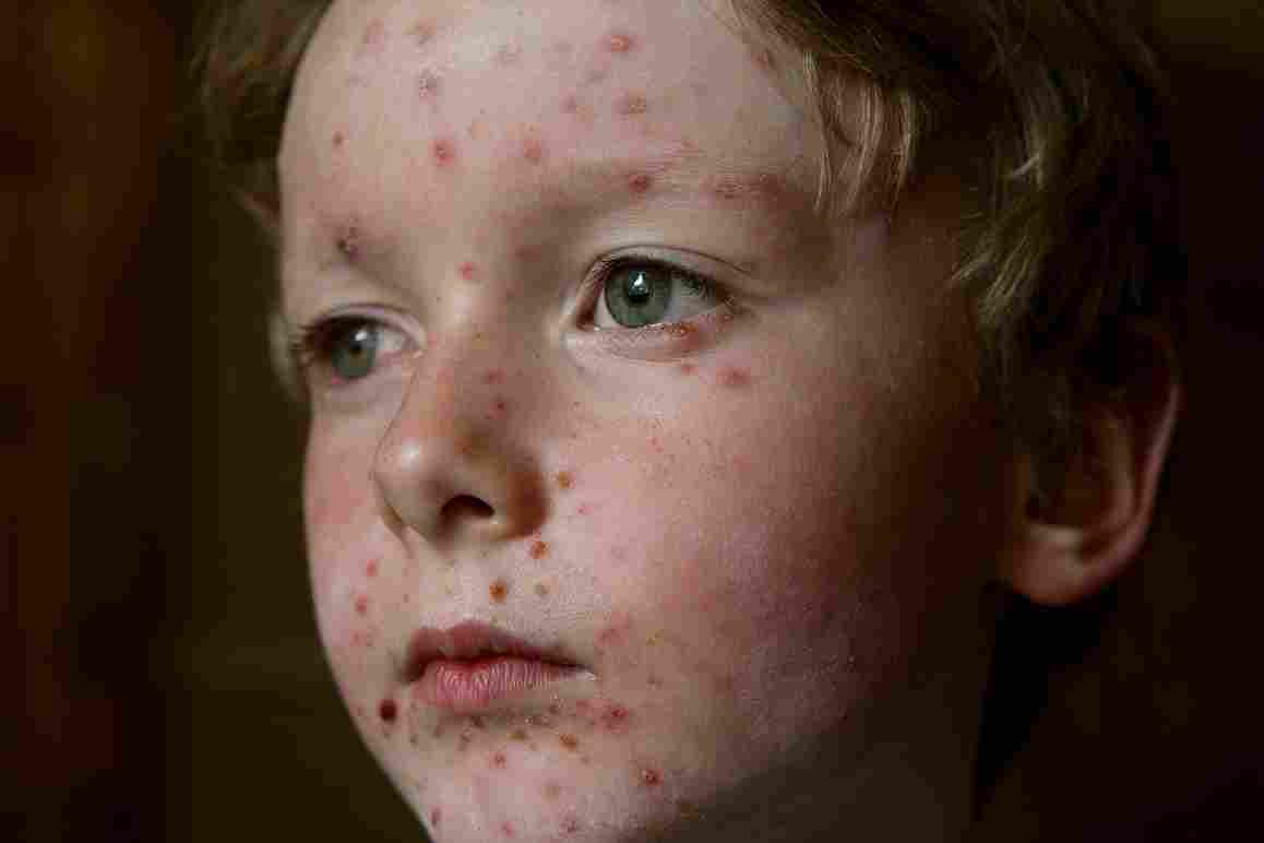 Home Remedies To Soothe Chicken Pox