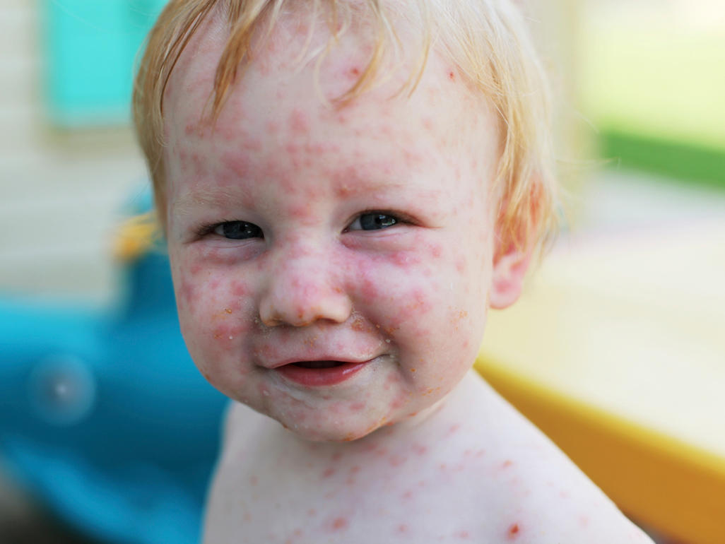 chickenpox3.jpg