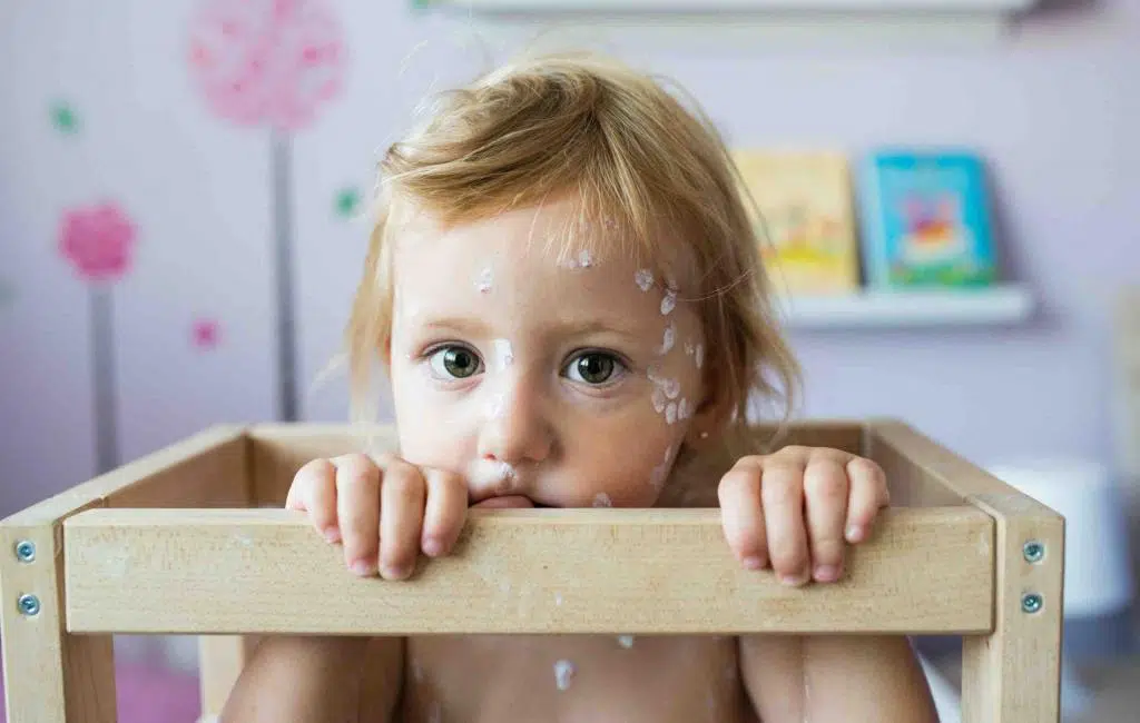 Everything You Should Know About Chickenpox