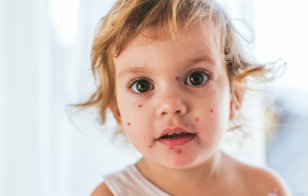 How To Protect Skin From Chickenpox Marks