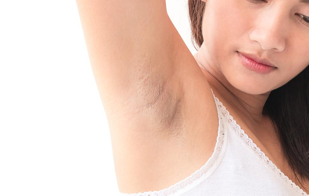 5 Reasons Why Your Armpits Are Dark