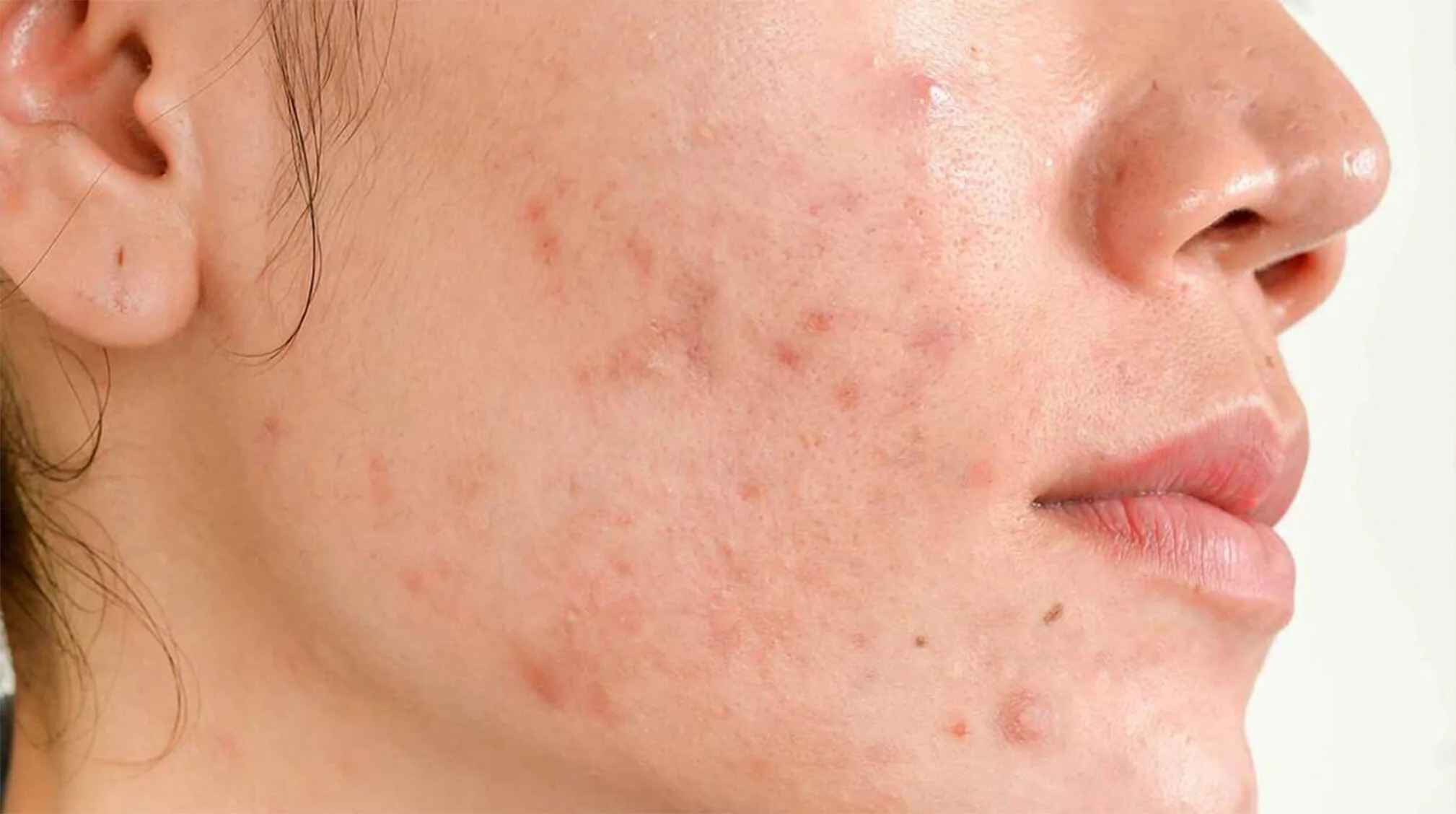 hormoal acne.jpg