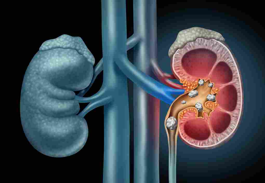 What Kidney Stones Can Do To Your Health?