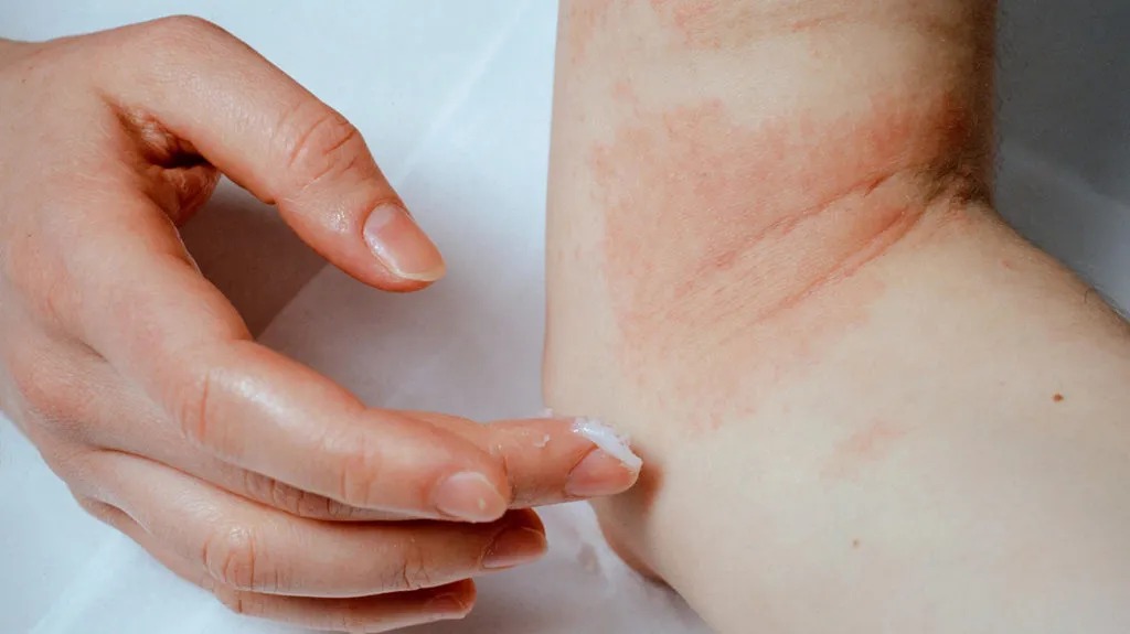 moisturize eczema_11zon.jpg