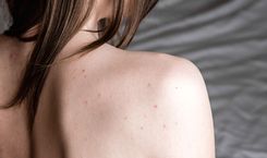 How to Treat Shoulder Acne at Home