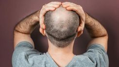 How To Manage Hair Loss In Men