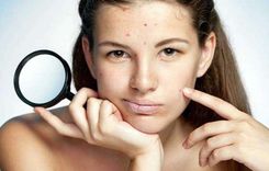 How to Get Rid of Pimple Spots with Easy Kitchen Remedies