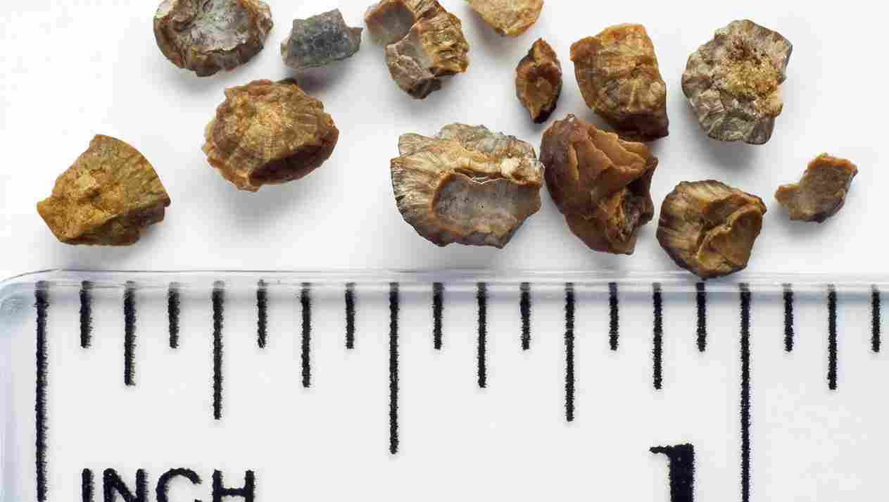 types of kidney stones.jpg